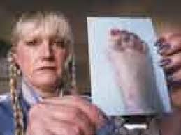 Dangerous mold creeps into houses, lungs, skin