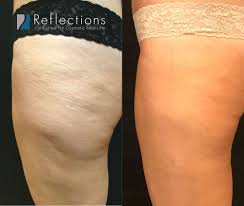 Stand barefoot on one leg for one minute, then switch sides. Thighs Saddlebags Before And After Photos New Jersey Reflections Center