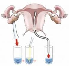 Eine künstliche samenübertragung (insemination) wird durchgeführt, wenn die zahl und paare, die sich für eine künstliche befruchtung entscheiden, sollten sich nicht nur der chancen, sondern auch. Die Kunstliche Befruchtung Ellviva