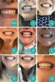 Smile Direct Club Invisible Aligner Review Smile Direct Smiledirectclub Smile Direct Club Reviews