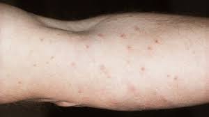 Image result for Trombicula autumnalis bites