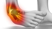 Image result for icd 10 code for left lateral ankle sprain