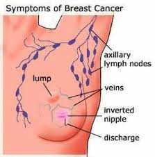 A breast cyst may appear before your menstrual period and get smaller or disappear afterward. Is Breast Lump Signal To Breast Cancer By Dr Swarup Kumar Ghosh Lybrate