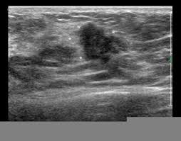 Finding breast lumps and seeing change in the size and shape. A Gallery Of High Resolution Ultrasound Color Doppler 3d Images Breast