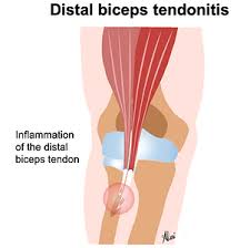 Image result for Biceps Tendon Injection