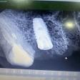 Dental implant, product image