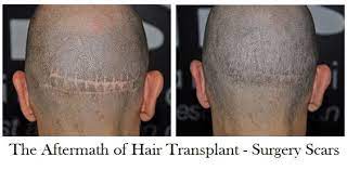 Pin On Hair Transplant