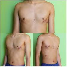 Image result for Pectus Excavatum