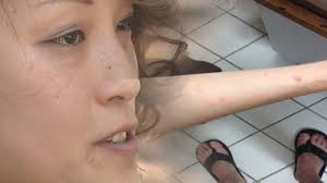 Lawsuit accuses Extended Stay America in Tamarac of bed bug infestation