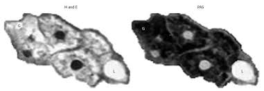 Diagnosis of hepatic glycogenosis in poorly controlled type 1 diabetes  mellitus