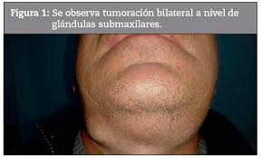 Image result for Sialoadenitis