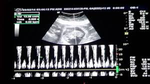 A theory that really works, here's how to use your scan to predict your baby's gender. Buy Fetal Heart Rate At 12 Weeks Gender Prediction