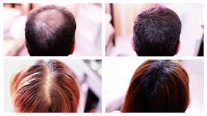 How To Cover Up Hair Loss Bald Spots Thinning Hair Receding Hairline Effectively A Must See Henna Hair Dyes Henna Hair Hairstyles For Thin Hair