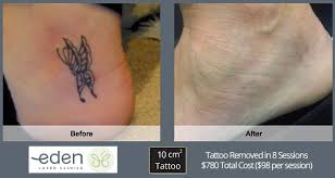 Also, come prepared to ask questions. Tattoo Archive Laser Tattoo Removal Sydney Tattoo Removal Guarantee