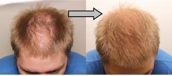 A wide variety of mane hair spray options are available to you, such as hair. Mane Hair Thickening Fibres And Spray Applicator Mane Uk Ltd