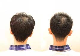 薄毛髪型 実録 前髪がかなり薄くなってしまっても薄毛をカバーできるヘアスタイルはきっとある inti report 薄毛に悩む男性の為の美容院 inti インティ 全席個室 東京 大阪 福岡に展開 薄毛 ヘアスタイリング ヘアスタイル