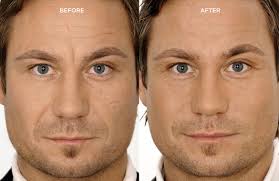 2 syringes of juvederm vollure. Men Cosmetic Dermatology Plastic Surgery California Skin Institute
