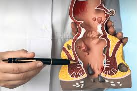 Image result for Hemorrhoid