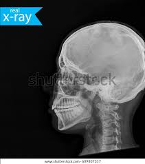 Image result for Skull XRay
