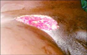 Image result for sore skin in the groin area