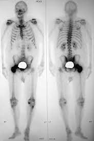 A bone scan can show whether any cancer cells have spread to your bones, which is a common place for prostate cancer to spread to. 70 Year Old Male With Prostate Carcinoma Radionuclide Bone Scan Of The Download Scientific Diagram