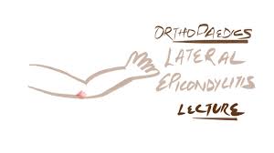 Lateral Epicondylitis Medical Videos Lecture Medical