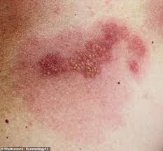 The sudden appearance of tiny red spots on skin can be shocking. Dermatologists Warn Red Spots Blisters And Itchy Wheals Could Be A Sign Of The Killer Coronavirus Daily Mail Online