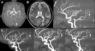 They account for the vast majority of intracranial aneurysms and are. A And C A Mycotic Aneurysm Arrow Is Observed In The Distal Part Of Download Scientific Diagram