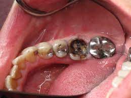 Less if you got them pulled or never got them.the person with the most teeth ever has 36 teeth. Dental Implant Or Root Canal Cost And Value Comparison Ramsey Amin Dds