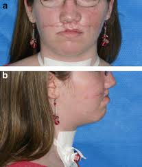 Secondary reconstruction of panfacial fractures
