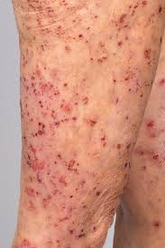 Image result for Pemphigoid