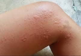 Pakar tidak mengetahui punca sebenar asma. Bukan Jilatan Jin Ini Sebenarnya Penyakit Gegata Yang Buat Anda Gatal Satu Badan