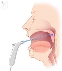 Image result for Radiofrequency Surgery