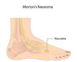 Exercises May Help Morton S Neuroma
