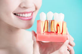 How Much do Dental Implants Cost? | Are You an Implant Candidate?
