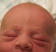 Eyes Newborn Nursery Stanford Medicine