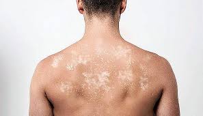 Weitere erkrankungen, bei denen clotrimazol häufig eingesetzt wird, sind zum beispiel das durch bakterien verursachte erythrasma und die durch hefepilze hervorgerufene pityriasis versicolor. Pitiriase Versicolor Ursachen Symptome Und Behandlung De Imevictoria Com
