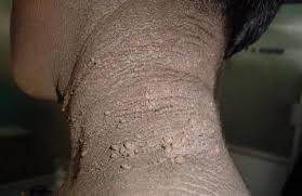 We did not find results for: Black Neck Causes Symptoms And Home Remedies