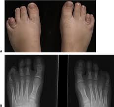 Long-term Donor Site Morbidity After Free Nonvascularized Toe Phalangeal  Transfer