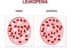 Nella popolazione piastrinica, oltre che evidenziare eventuali patologie correlate come trombocitosi o piastrinopenia. Leucopenia Sintomi Cause E Trattamento