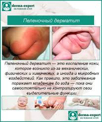 Chto Takoe Pelenochnyj Dermatit U Novorozhdennyh I Kak Pravilno Ego Lechit Oficialnyj Sajt Gbuz Rodilnyj Dom 2 G Magnitogorsk