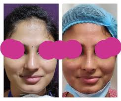 Nose Surgery Cost Bangalore Leading Nose Reshaping Rhinoplasty Surgeon In India