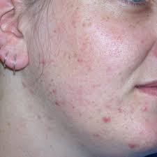 Here are some remedies that can be awesome in treating the chin acne quickly. Difference Between Blackheads And Pimples