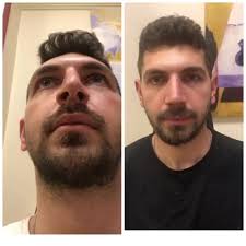 1. ay paylaşımı. Paylaşıma izin verdiği için değerli hastama teşekkür  ederim.,  #rinoplasti#burunestetiği#istanbulburunestetiği#doğalburun#rahatnefes#nosejob#rhinoplasty#letdownrhinoplasty#letdown#push...