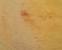 Tiny Red Blood Spots On Skin