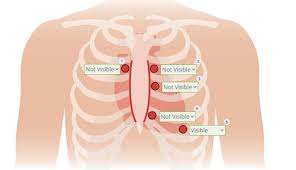 Image result for Point of Maximum Impulse