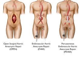 Costul unei operaţii de transplant de. EndoprotezÄƒ Vs Chirurgie DeschisÄƒ In Tratamentul Anevrismelor Aortice Vascular Blog