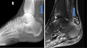 Image result for Calcaneus