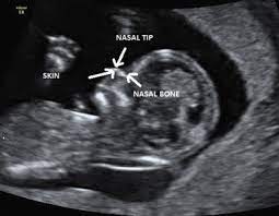 A Review Of Ultrasound Imaging Techniques For The Detection Of Down Syndrome Sciencedirect