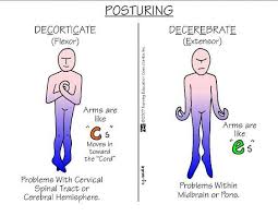 Decorticate Vs Decerebrate Posturing Nursing Med Surg Medical Surgical Nursing Surgical Nursing Nursing Mnemonics